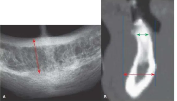 Figura  4  -  Radiografia  Oclusal.  A  -  A  radiografia  oclusal  fornece  informação  acerca  da  largura  de  osso na região anterior; B - No entanto, estas radiografias mostram a distância vestíbulo-lingual mais  larga (seta vermelha), sendo que a dim