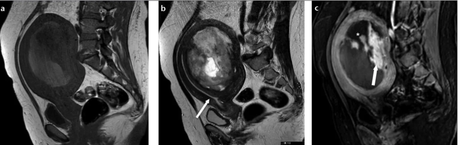 Figure 2. a, b. Leiomyosarcoma in a 54-year-old woman. Axial DWI on b1000 (a) demonstrates  a hyperintense mass