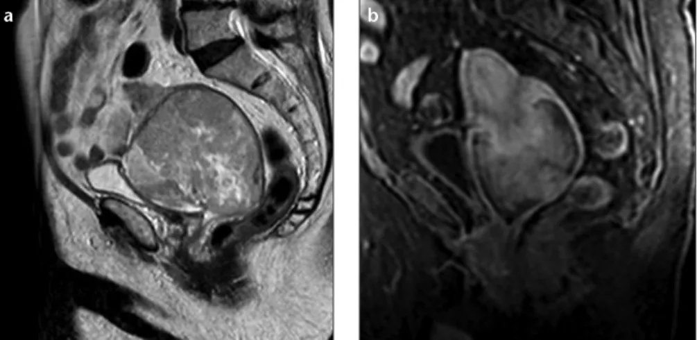 Figure 4. a, b. Sagittal (a) and axial (b) T2-weighted images show an endometrial stromal  sarcoma in a 64-year-old woman