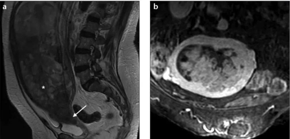 Figure 6. a, b. Adenosarcoma in a 76-year-old woman. Sagittal T2-weighted image (a) and  oblique coronal T1-weighted image with fat suppression, after contrast administration (b) show a  very large polypoid mass with heterogeneous high signal intensity ari