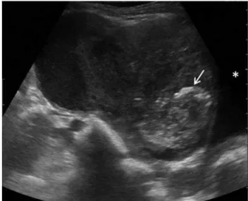 Fig. 1 Pelvic ultrasonography revealed a large complex cystic mass with cal- cal-cifications (arrow) located superiorly to the bladder (  )