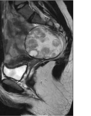 Figure 4 Coronal T2-weighted image