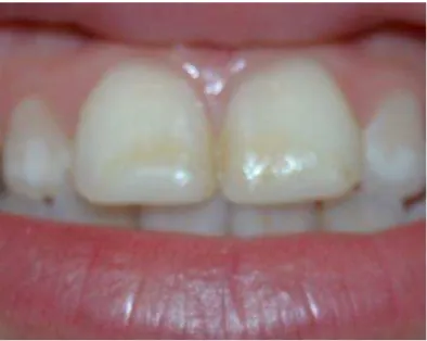 Figura 21: Traumatismo dentário do dente 11 e 21 tratado com restauração a compósito. 