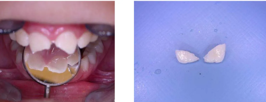 Figura 5. Fractura de esmalte e dentina (à esquerda) e respectivo fragmento (à direita)