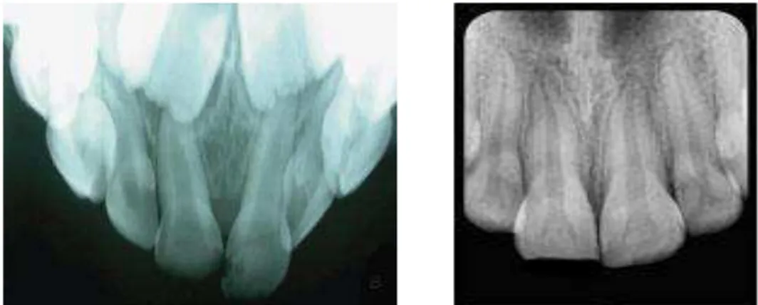 Figura 6. Imagem radiográfica de fractura de esmalte e dentina na dentição decídua (à esquerda) e na  dentição permanente (à direita)