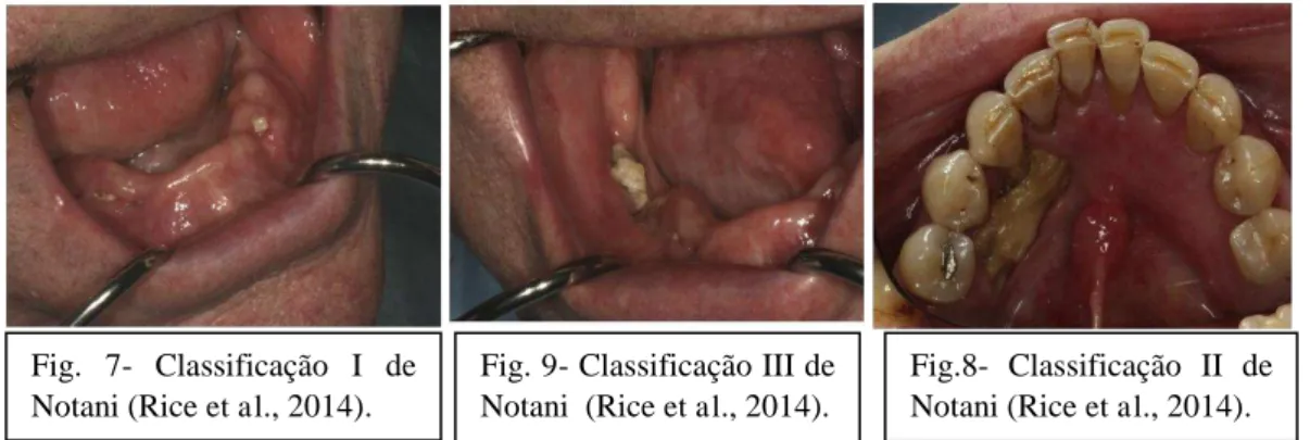 Fig. 9- Classificação III de  Notani  (Rice et al., 2014). 