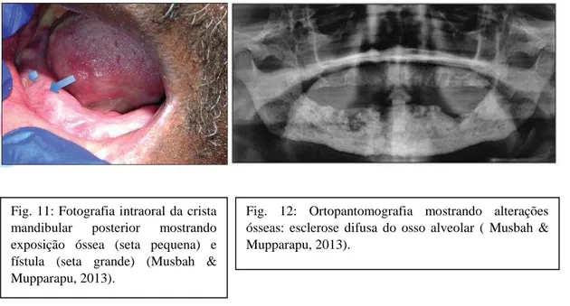 Fig. 11: Fotografia intraoral da crista  mandibular  posterior  mostrando  exposição  óssea  (seta  pequena)  e  fístula  (seta  grande)  (Musbah  &amp; 