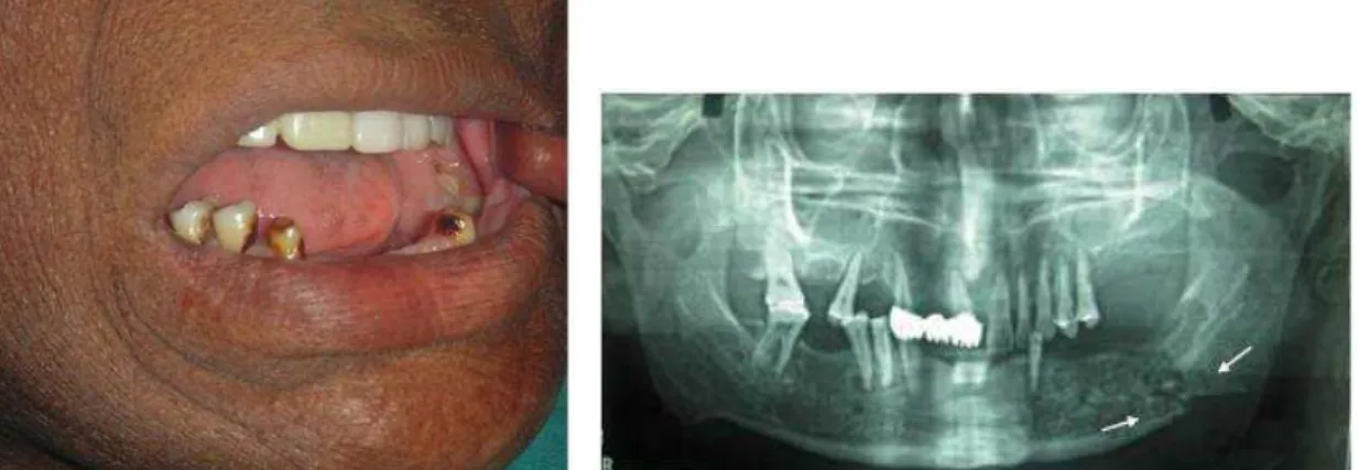 Fig.  13:  Mostra  uma  porção  de  osso  irradiado  exposto  na  região  retro  molar  (Lambade et al., 2013)