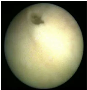Fig. 4 Endoscopic view of the bladder orifice at the end of the procedure
