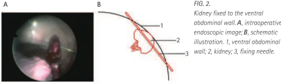 FIG.   1.   Schematic illustraction of transvesical  access to the peritoneal cavity and the selected  kidney