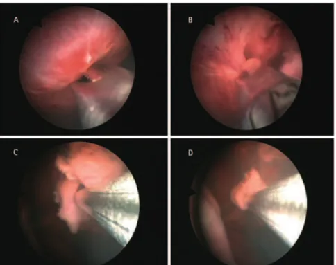 FIG.   3.   Morcellation.   A , Morcellator approaches the kidney;   B,  start of morcellation;   C, D,  end of  morcellation: kidney almost unstructured