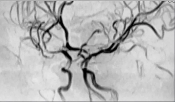 Fig 3. MR-angiography, 3D Time-of-light at 3 month follow up, dem- dem-onstrates reversion of stenosis of M1 segment.