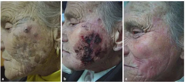 Fig. 1. Extensive LM of the face. a Before treatment with imiquimod. b Cutaneous inflammation after  1 month of treatment