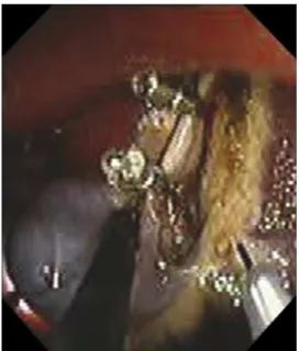 Figure 4. Beginning of gallbladder-bed dissection. By using electrocau- electrocau-tery, gallbladder bed dissection was carefully undertaken step-by-step.