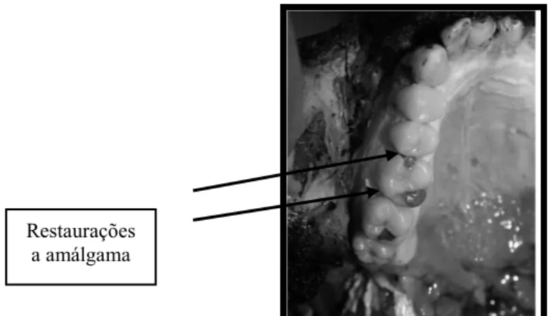 Figura  1 - Dentes posteriores preservados numa vítima queimada, com restaurações em amálgama (setas) -  fator de individualização do cadáver (modificado de Mclay, 2009)