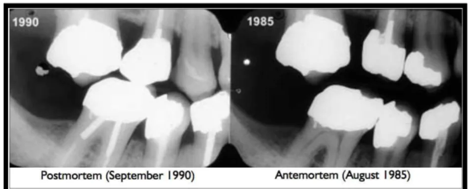 Figura  2 - Exemplo de radiografias postmortem (1990) e antemortem (1985) para determinação da idade (Pretty 
