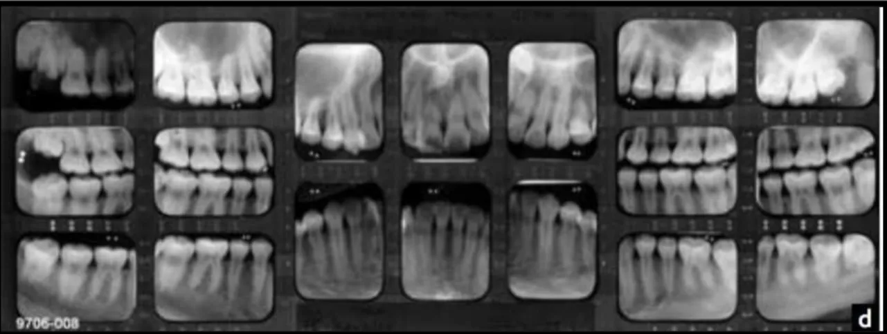Figura  3 - Radiografia postmortem a toda a cavidade oral composta por bitewings e periapicais (Pretty &amp; 