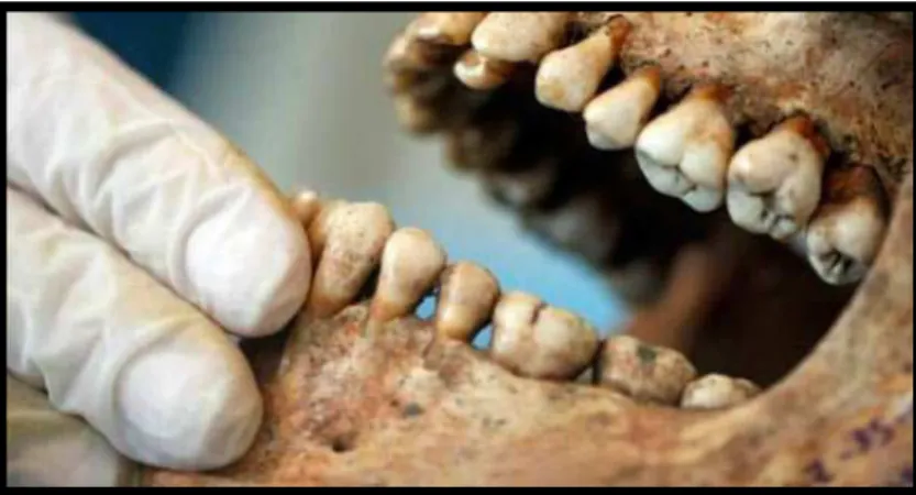 Figura  6 - Mandíbula e maxila postmortem com evidência de patologia periodontal  (https://i2.wp.com/diariodebiologia.com/wpcontent)