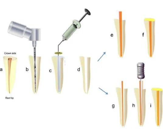 Figura 3: Esquema de obturação com condensação lateral e cone único. Raiz (a); instrumentação  (b); irrigação (c) canal limpo (d)