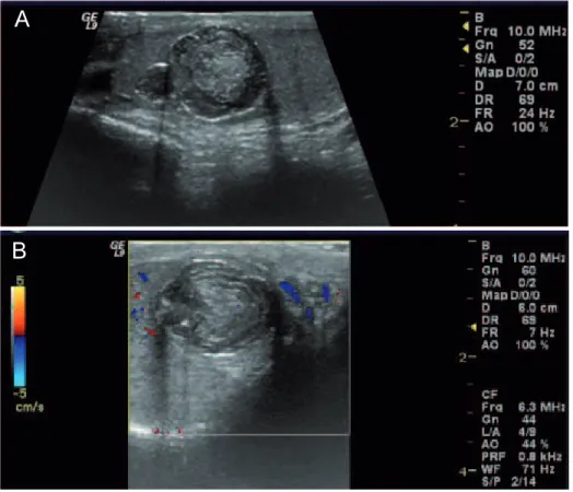 Figure 1 - a. Longitudinal US image of the right testis show a bilobulated mass in the upper medial aspect of the testis