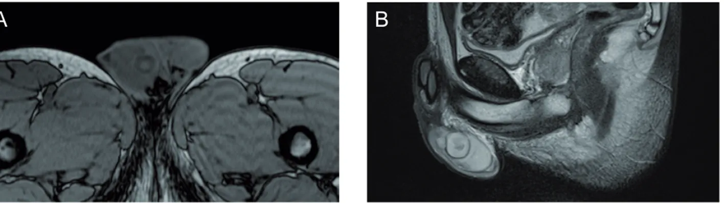 Figure 2 - a.  Axial T2-weigthed image conirms the well-circumscribed mass in the upper medial pole of the right testis