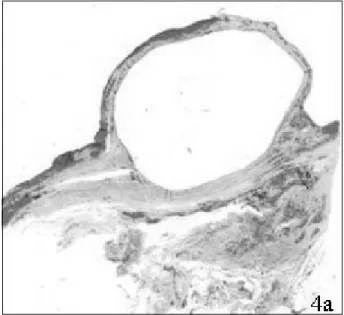 Fig. 3 – Aspecto macroscópico da peça de tumorectomia e coccigectomia.  a – Superfície interna do tumor.