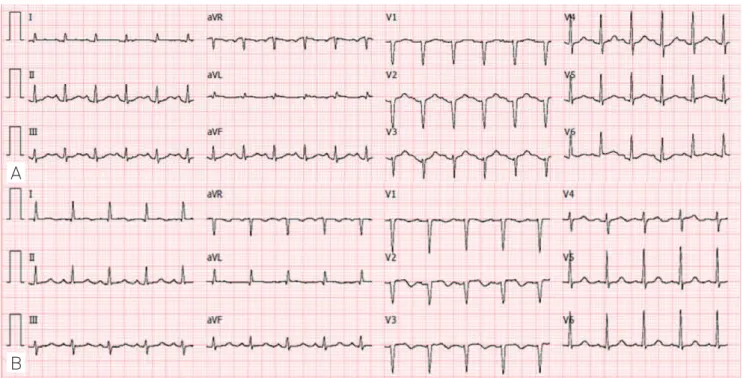 Fig 2. Ventriculography with typical left ventricular apical  ballooning — hypocontractility of the apical segments and  hypercontractility of the basal segments.