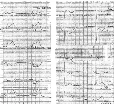 Fig. 3  ECG num episódio dolo- dolo-roso mostrando elevação do  seg-mento ST em II-III-a e V 5 -V 6 
