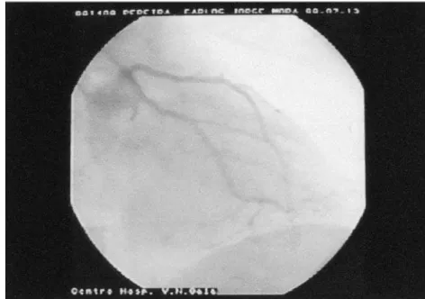 Fig. 4  Coronariografia do doente n.º 2.