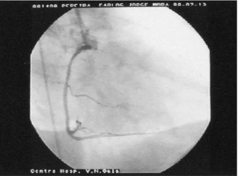 Fig. 5  Coronariografia do doente n.º 2.