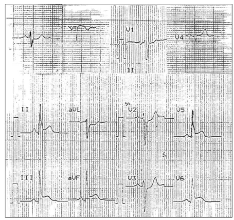 Fig. 6  Prova de esforço com ele- ele-vação do segmento ST em  II-III-aVF e V 5 -V 6 no pico do exercício.