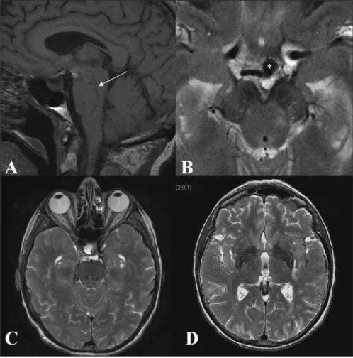 Figure 2: MR study: sagittal T1 (A) shows evolution of the vertically elongated brainstem hematoma with central methemoglobin and hemosiderin rim (long arrow)