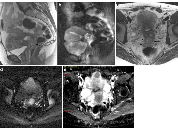 Fig. 4 Sagittal and axial T2W images, MRI; DWI images with ADC map (B 800). 42 years old woman, stage IIB cervical carcinoma