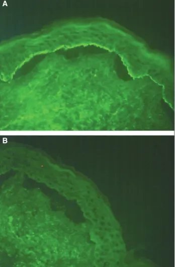 Figure 1. IIF using 1 mol/L NaCl split normal human skin as a substrate.