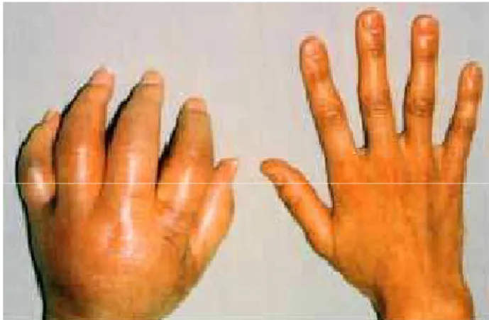 Fig. 1 – SDRC tipo I afectando o membro superior