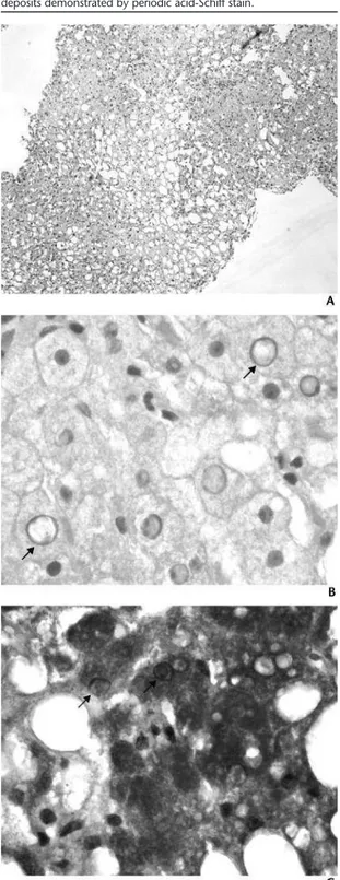 FIGURE 1: Liver histology. (A) Macrovesicular steatosis (hematoxylin and eosin). (B) Enlarged nuclei (arrows) with peripherally displaced material suggesting accumulation of substance inside (hematoxylin and eosin)