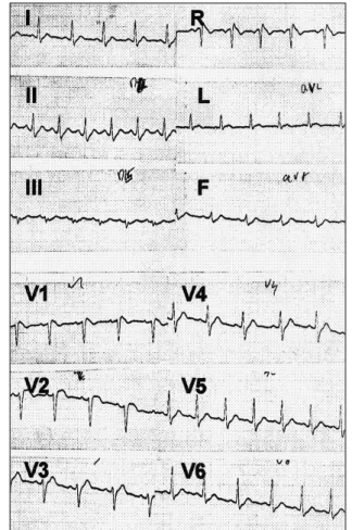 Fig. 1 Electrocardiogram of 03.02.99 showing, in V1 and V2, the elevation of J wave and ST segment, followed by  neg-ative T wave, characteristic of Brugada syndrome.