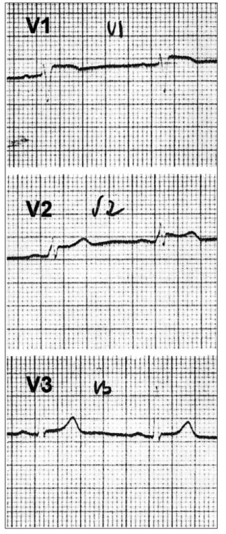 Fig. 3 Árvore genealógica. Os quadrados representam os in- in-divíduos de sexo masculino e os círculos os de sexo  femi-nino