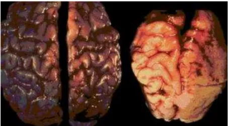 Figura 2 6 –  Cérebro normalmente desenvolvido versus cérebro desenvolvido com exposição ao  álcool