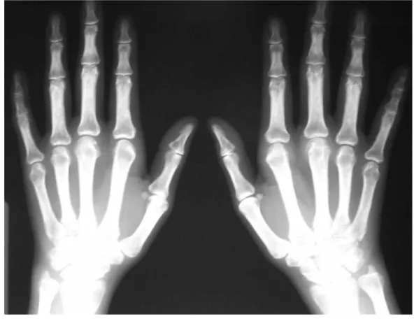 Figura 2: Aspecto radiográfico da artrite reumatóide na fase inicial (paciente com 28  semanas de sintomas): radiografia das mãos em antero-posterior, demonstrando  rarefação óssea peri-articular e erosões subcondrais incipientes nas interfalangeanas 