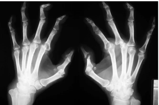 Figura 3: Aspecto radiográfico da artrite reumatóide na fase avançada (paciente com  5 anos de diagnóstico): radiografia das mãos em ântero-posterior, mostrando 