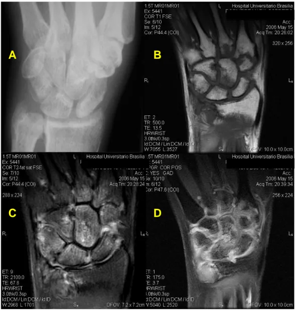 Figura 04: Aspecto radiográfico de artrite reumatóide em fase inicial (22 semanas de  sintomas)