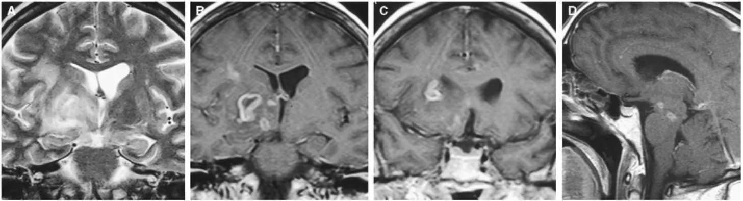 Figure 2 L’image pond´ er´ ee en diffusion (A) et la cartographie ADC (B) montrent une restriction de la diffusion au niveau du noyau lenticulaire droit.