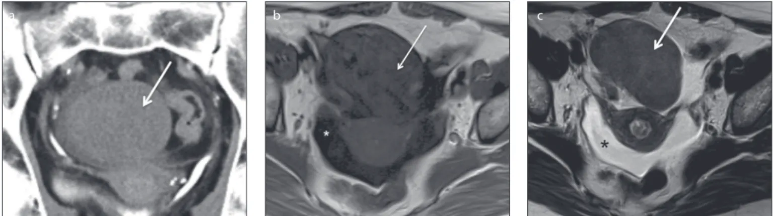 Figure 2. a–c. A 50-year-old female patient with a right ovarian cellular ibroma. Axial T1-weighted (a), T2-weighted (b) and gadolinium-enhanced fat- fat-suppressed T1-weighted (c) images show a large, heterogeneous and well-deined tumor of the right ovary
