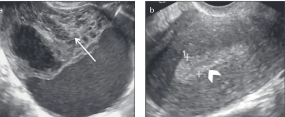 Figure 8. a, b. A 40-year-old female patient with a right ovarian adult granulosa cell tumor