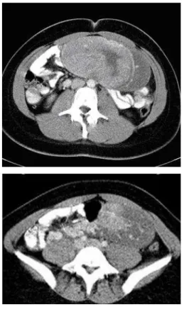 Figure 1 Axial CT after contrast administration 