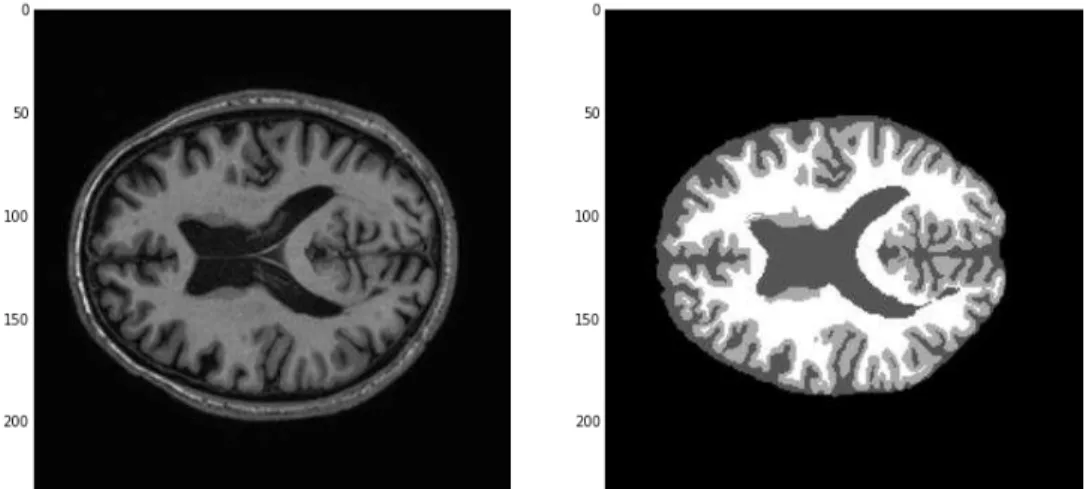Figura 15 - Exemplo de imagens da base de dados MRBrainS. Esquerda: imagem T1-weighted  3D do MRBrainS, Direita: Marcação do médico (Ground Truth)