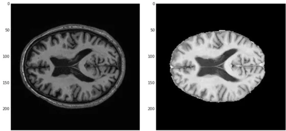 Figura 18 - Histograma das intensidades de cada tecido cerebral. 1º: Líquido Cerebrospinal,  2º: Substância Cinzenta, 3º: Substância Branca, 4º: Todos os tecidos