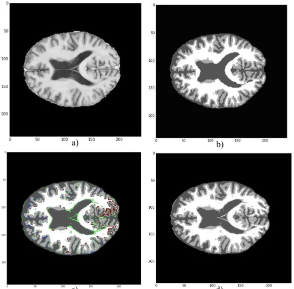 Figura 23 - Exemplo da segmentação dos tecidos cerebrais por modelos de mistura Gaussianos por  processos  de  Dirichlet