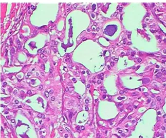 Figure 1 Solid and acinar neoplastic structures with abundant luminal secretion.